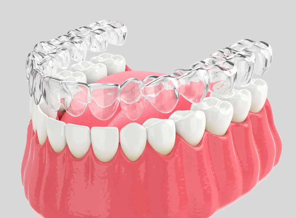 Smilelign clear braces for teeth
